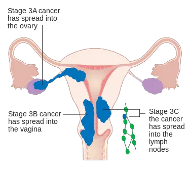 MEDICINA ONLINE TUMORE ENDOMETRIO STADIO