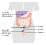 MEDICINA ONLINE TUMORE ENDOMETRIO STADIO