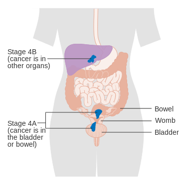 MEDICINA ONLINE TUMORE ENDOMETRIO STADIO