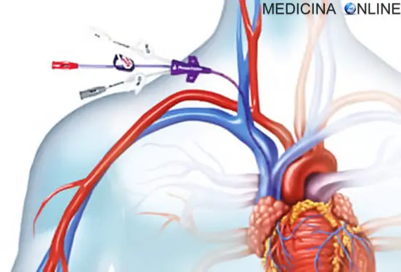 MEDICINA ONLINE CATETERE VENOSO CENTRALE NON TUNNELLIZZATO VENA CATETERE NON TUNNELLED.jpg