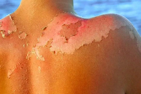 MEDICINA ONLINE EMILIO ALESSIO LOIACONO MEDICO CHIRURGO PELLE SCOTTATURA SPELLATA SOLE ABBRONZATURA TROPPO SOLE CREMA SOLARE UVA UVB RUGHE MARE ESTATE CALDO RAGGI DI SOLE NUVOLE TEMPERATURE INSOLAZIONE