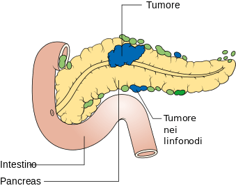 MEDICINA ONLINE TUMORE PANCREATICO STADIO DIFFUSIONE AI LINFONODI N1