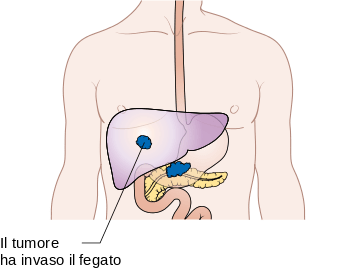 MEDICINA ONLINE TUMORE PANCREATICO STADIO DIFFUSIONE METASTATICA M1