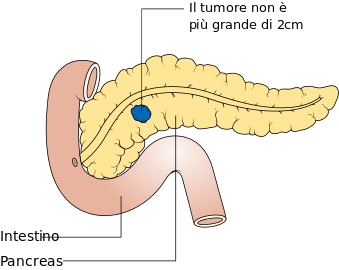 MEDICINA ONLINE TUMORE PANCREATICO STADIO T1