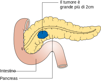 MEDICINA ONLINE TUMORE PANCREATICO STADIO T2