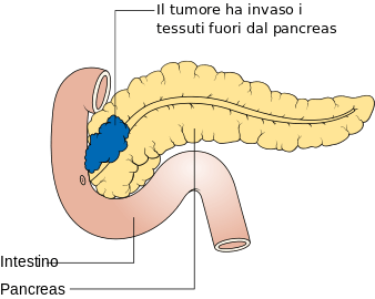 MEDICINA ONLINE TUMORE PANCREATICO STADIO T3