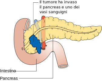 MEDICINA ONLINE TUMORE PANCREATICO STADIO T4