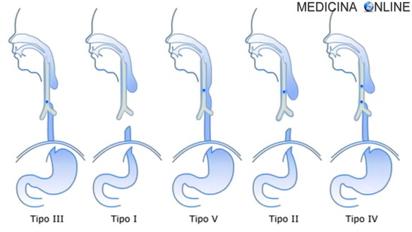 MEDICINA ONLINE ATRESIA ESOFAGEA ESOFAGO NEONATO INTERVENTO FISTOLA TIPI TRACHEA PASSAGGIO CIBO LATTE OSTRUZIONE CHIRURGIA TECNICA TERAPIA RISCHI CONSEGUENZE PER IL BAMBINO FETO MALFORMAZIONE MADRE POLIDRAMNIOS.jpg