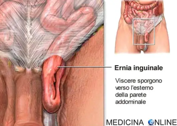 MEDICINA ONLINE ERNIA ADDOMINALE INGUINALE IATALE CRURALE OMBELICALE DISCO ESOFAGEA CEREBRALE CEREBELLARE TORACICA INTERNA ESTERNA PORTA SACCO CONTENUTO SCROTO TESTICOLI INTESTINO CONGENITE ACQUISITE.jpg
