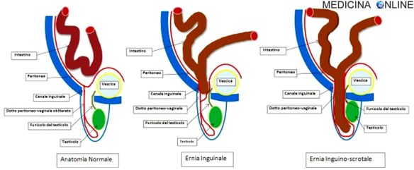 MEDICINA ONLINE ERNIA ADDOMINALE INGUINALE IATALE CRURALE OMBELICALE DISCO ESOFAGEA CEREBRALE CEREBELLARE TORACICA INTERNA ESTERNA PORTA SACCO CONTENUTO SCROTO TESTICOLI INTESTINO CONGENITE ACQUISITE.jpg