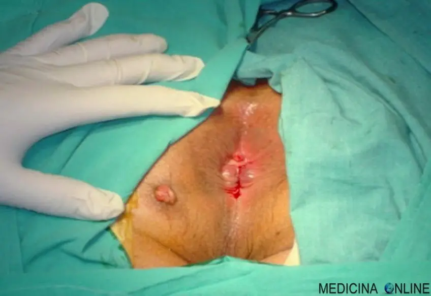 MEDICINA ONLINE FISTOLA IMMAGINE