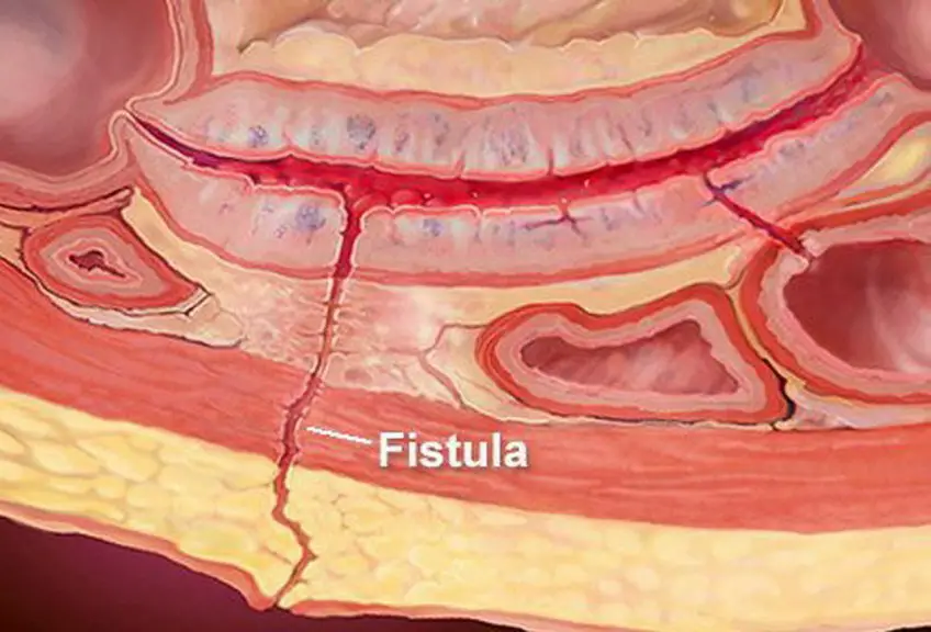 MEDICINA ONLINE FISTOLA IMMAGINE