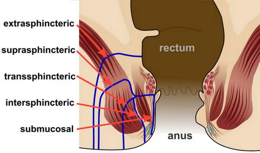 MEDICINA ONLINE FISTOLA IMMAGINE
