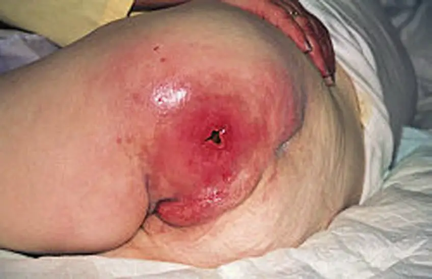 MEDICINA ONLINE FISTOLA IMMAGINE