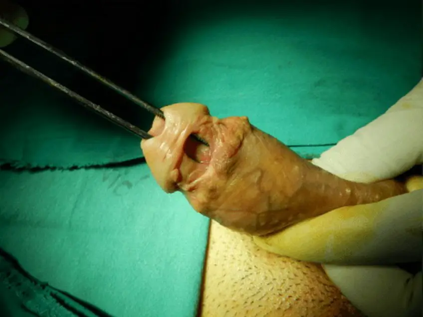 MEDICINA ONLINE FISTOLA IMMAGINE