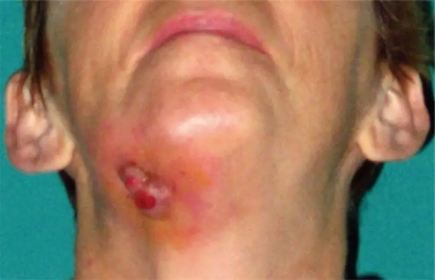 MEDICINA ONLINE FISTOLA IMMAGINE
