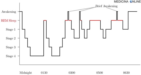 MEDICINA ONLINE IPNOGRAMMA SONNO DORMIRE STEP FASE REM RAPID EYES OCCHI MOVIMENTI SOGNO INSONNIA JET LAG MELATONINA Sleep Hypnogram