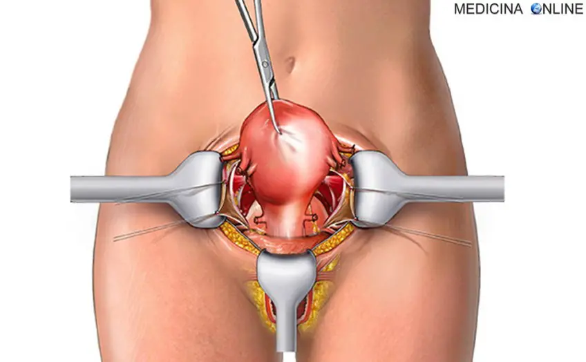 MEDICINA ONLINE LAPAROTOMIA GINECOLOGICA RISCHI COMPLICANZE LAPAROSCOPIO VAGINA UTERO OVAIO GRAVIDRANZA EXTRAUTERINA VANTAGGI gynecologic laparoscopy