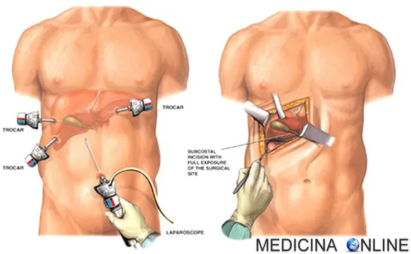 MEDICINA ONLINE LAPAROTOMIA LAPAROSCOPIA CHIRURGIA OPEN CHIUSA ENDOSCOPIO ENDOSCOPIA IMMAGINI CHIRURGO TAGLIO VANTAGGI SVANTAGGI RISCHI COLECISTECTOMIA SANGUE OPERAZIONE CHIRURGICA ANESTESILAPAROSCOPIC LAPAROTOMY CHOLECYSTE.jpg