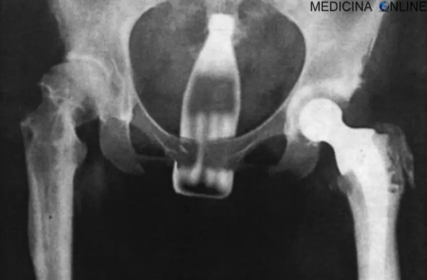 MEDICINA ONLINE OGGETTI CORPO ESTRENEO ANO BAMBINO ESOFAGO STOMACO BATTERIE SEX TOYS OGGETTI SESSO GIOCATTOLI TOSSICI BOTTIGLIA PENNA PENNARELLO COLON RETTO RISCHI COSA FARE COLONSCOPIA INTESTINO DIGERENTE RX RADIOGRAFIA