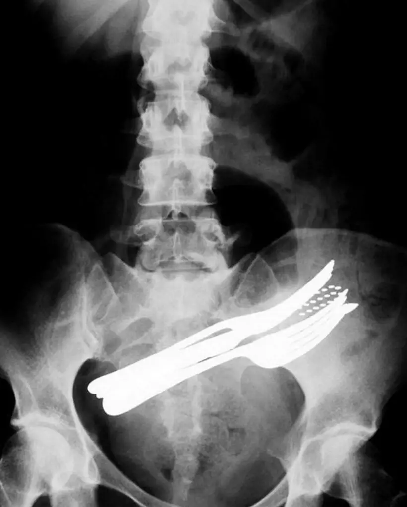 MEDICINA ONLINE OGGETTI CORPO ESTRENEO ANO BAMBINO ESOFAGO STOMACO BATTERIE SEX TOYS OGGETTI SESSO GIOCATTOLI TOSSICI BOTTIGLIA PENNA PENNARELLO COLON RETTO RISCHI COSA FARE COLONSCOPIA INTESTINO DIGERENTE RX RADIOGRAFIA