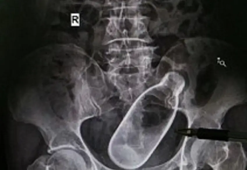 MEDICINA ONLINE OGGETTI CORPO ESTRENEO ANO BAMBINO ESOFAGO STOMACO BATTERIE SEX TOYS OGGETTI SESSO GIOCATTOLI TOSSICI BOTTIGLIA PENNA PENNARELLO COLON RETTO RISCHI COSA FARE COLONSCOPIA INTESTINO DIGERENTE RX RADIOGRAFIA