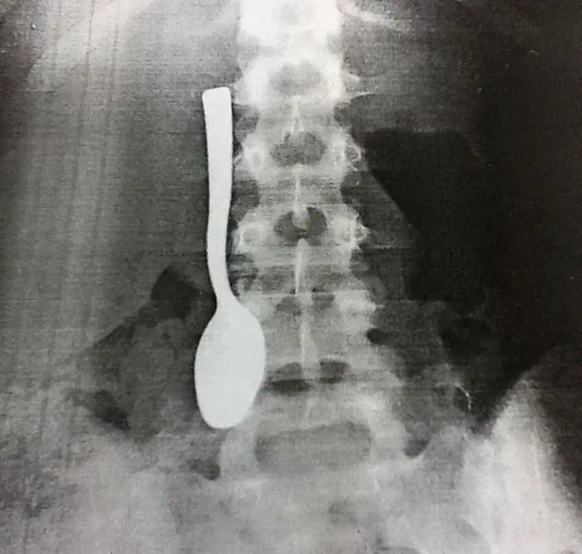 MEDICINA ONLINE OGGETTI CORPO ESTRENEO ANO BAMBINO ESOFAGO STOMACO BATTERIE SEX TOYS OGGETTI SESSO GIOCATTOLI TOSSICI BOTTIGLIA PENNA PENNARELLO COLON RETTO RISCHI COSA FARE COLONSCOPIA INTESTINO DIGERENTE RX RADIOGRAFIA