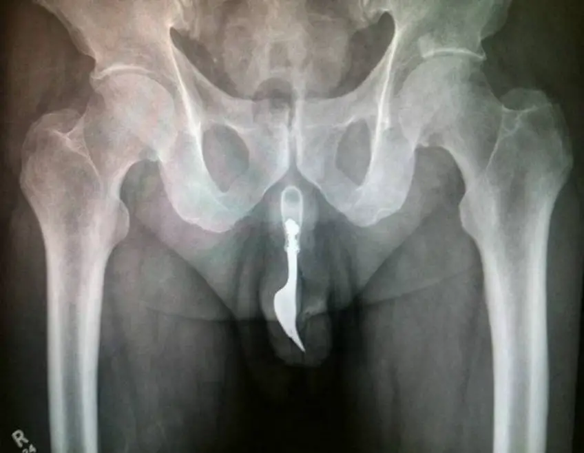 MEDICINA ONLINE OGGETTI CORPO ESTRENEO ANO BAMBINO ESOFAGO STOMACO BATTERIE SEX TOYS OGGETTI SESSO GIOCATTOLI TOSSICI BOTTIGLIA PENNA PENNARELLO COLON RETTO RISCHI COSA FARE COLONSCOPIA INTESTINO DIGERENTE RX RADIOGRAFIA