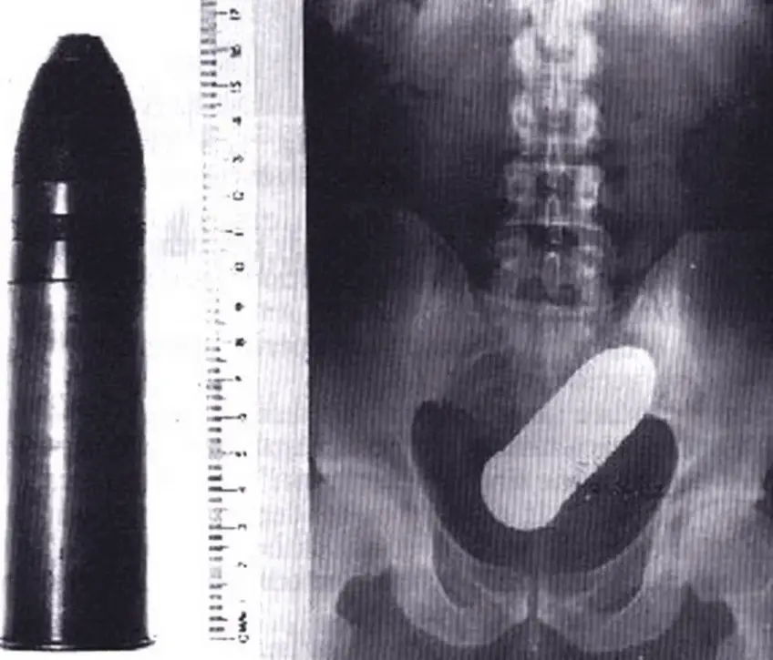 MEDICINA ONLINE OGGETTI CORPO ESTRENEO ANO BAMBINO ESOFAGO STOMACO BATTERIE SEX TOYS OGGETTI SESSO GIOCATTOLI TOSSICI BOTTIGLIA PENNA PENNARELLO COLON RETTO RISCHI COSA FARE COLONSCOPIA INTESTINO DIGERENTE RX RADIOGRAFIA