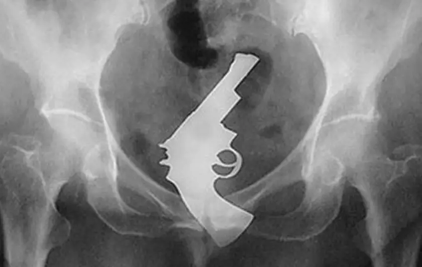 MEDICINA ONLINE OGGETTI CORPO ESTRENEO ANO BAMBINO ESOFAGO STOMACO BATTERIE SEX TOYS OGGETTI SESSO GIOCATTOLI TOSSICI BOTTIGLIA PENNA PENNARELLO COLON RETTO RISCHI COSA FARE COLONSCOPIA INTESTINO DIGERENTE RX RADIOGRAFIA