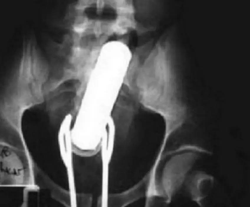 MEDICINA ONLINE OGGETTI CORPO ESTRENEO ANO BAMBINO ESOFAGO STOMACO BATTERIE SEX TOYS OGGETTI SESSO GIOCATTOLI TOSSICI BOTTIGLIA PENNA PENNARELLO COLON RETTO RISCHI COSA FARE COLONSCOPIA INTESTINO DIGERENTE RX RADIOGRAFIA