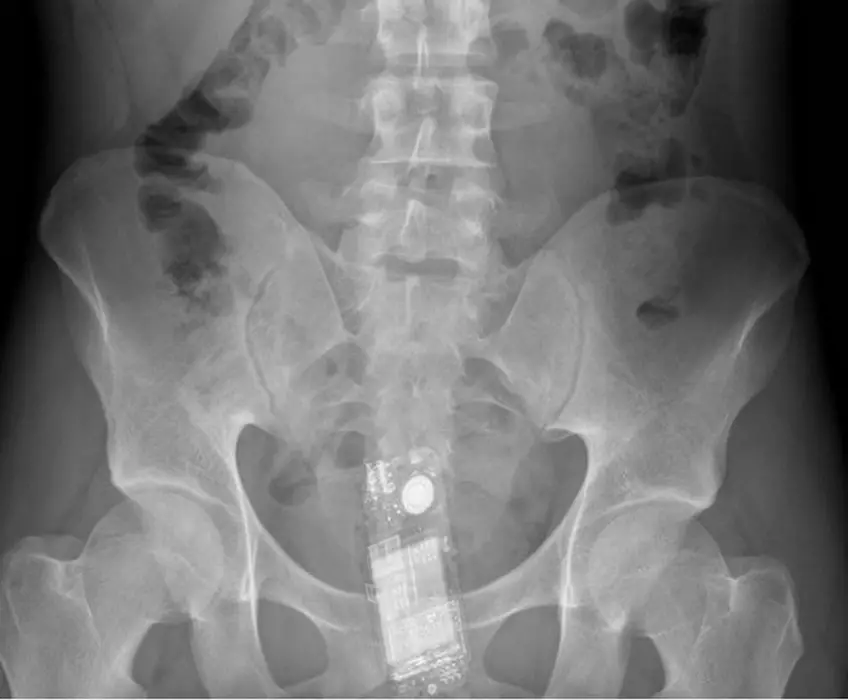 MEDICINA ONLINE OGGETTI CORPO ESTRENEO ANO BAMBINO ESOFAGO STOMACO BATTERIE SEX TOYS OGGETTI SESSO GIOCATTOLI TOSSICI BOTTIGLIA PENNA PENNARELLO COLON RETTO RISCHI COSA FARE COLONSCOPIA INTESTINO DIGERENTE RX RADIOGRAFIA