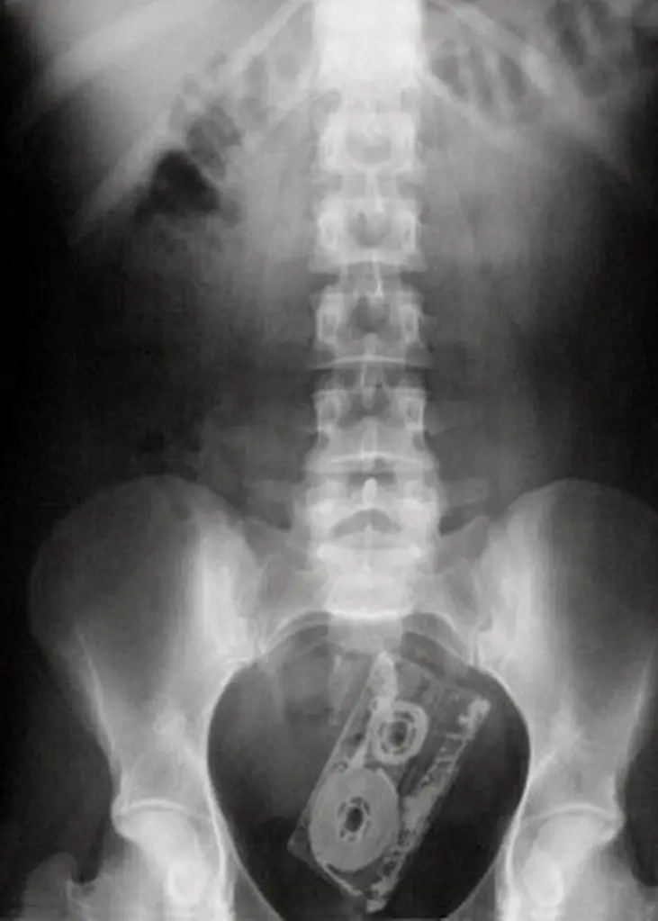 MEDICINA ONLINE OGGETTI CORPO ESTRENEO ANO BAMBINO ESOFAGO STOMACO BATTERIE SEX TOYS OGGETTI SESSO GIOCATTOLI TOSSICI BOTTIGLIA PENNA PENNARELLO COLON RETTO RISCHI COSA FARE COLONSCOPIA INTESTINO DIGERENTE RX RADIOGRAFIA