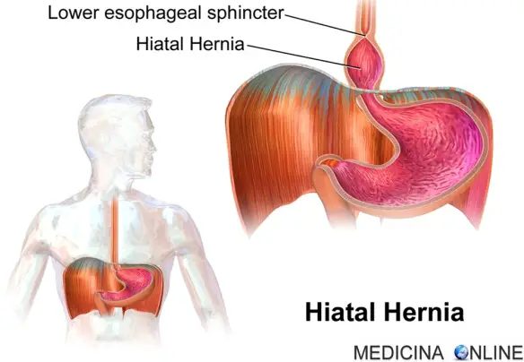 MEDICINA ONLINE STOMACO DIAFRAMMA IATO ERNIA IATALE JATALE HIATAL HERNIA DA SCIVOLAMENTO PARAESOFAGEA SFINTERE BARRETT METAPLASIA TUMORE CIBO REFLUSSO GASTROESOFAGEO ACIDO BOCCA SAPORE NOTTE ACIDITA ADDOME TORACE