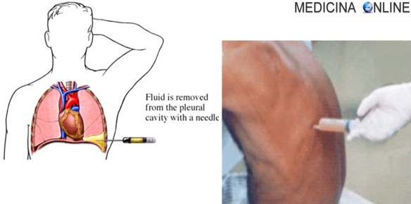 MEDICINA ONLINE TORACENTESI TORACOCENTESI TORACE PLEURE POLMONI LIQUIDO PLEURICO CAVO SPAZIO VERSAMENTO ESSUDATO TRASUDATO EDEMA INFIAMMATORIO NON PROTEINE INFEZIONI EMBOLIA.jpg