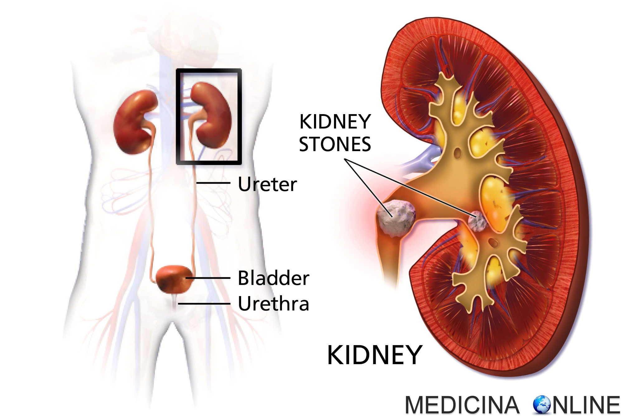 Kidney stone перевод