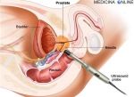 MEDICINA ONLINE BIOPSIA PROSTATICA TRANSRETTALE prostate biopsy transrectal