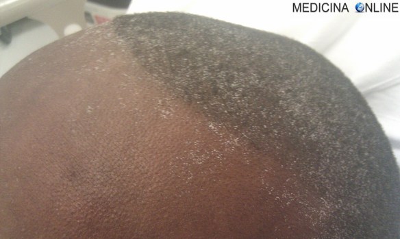 MEDICINA ONLINE BRINA UREMICA UREMIA INSUFFICIENZA RENALE CRONICA DIALISI TRAPIANTO DI RENE.jpg