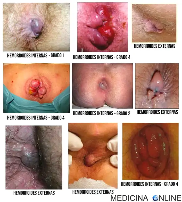 MEDICINA ONLINE EMORROIDI INTERNE ESTERNE CAUSE SINTOMI CURA RIMEDI DOLORE SANGUE CHIRURGIA FA MALE DOLOROSO TRATTAMENTO RIMEDI CONSIGLI STIPSI FECI FECALOMA HEMORRHOIDS ANO RETTO IMMAGINI FOTO