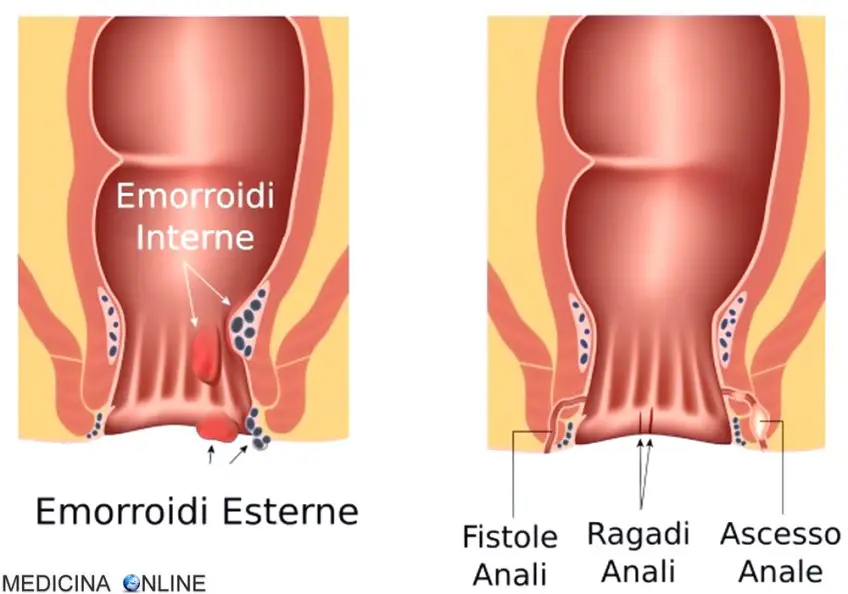 MEDICINA ONLINE FISTOLA ANALE IMMAGINE