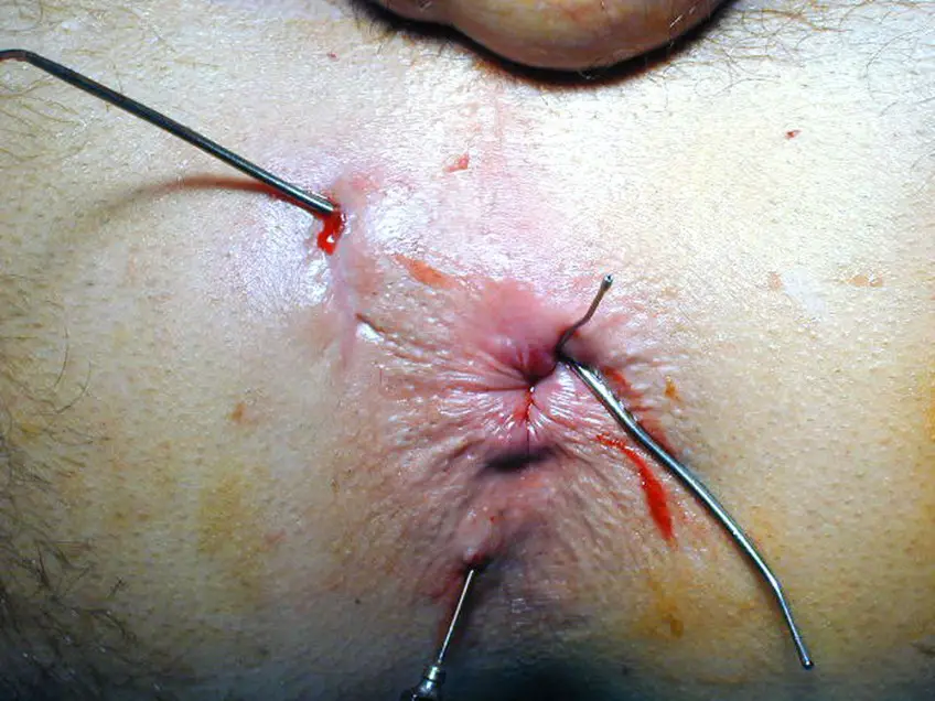 MEDICINA ONLINE FISTOLA ANALE IMMAGINE