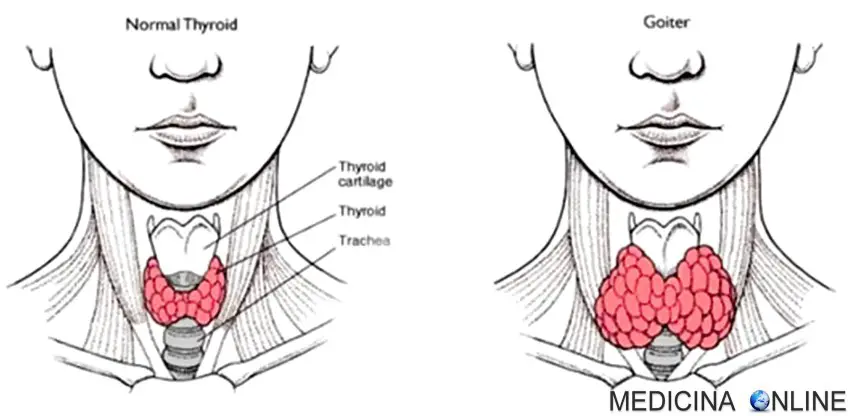MEDICINA ONLINE GOZZO TIROIDEO IMMAGINE