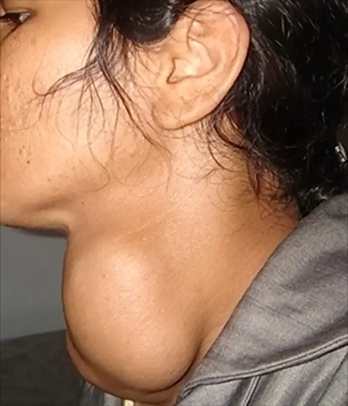 MEDICINA ONLINE GOZZO TIROIDEO IMMAGINE