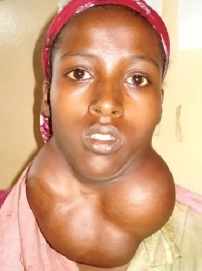 MEDICINA ONLINE GOZZO TIROIDEO IMMAGINE