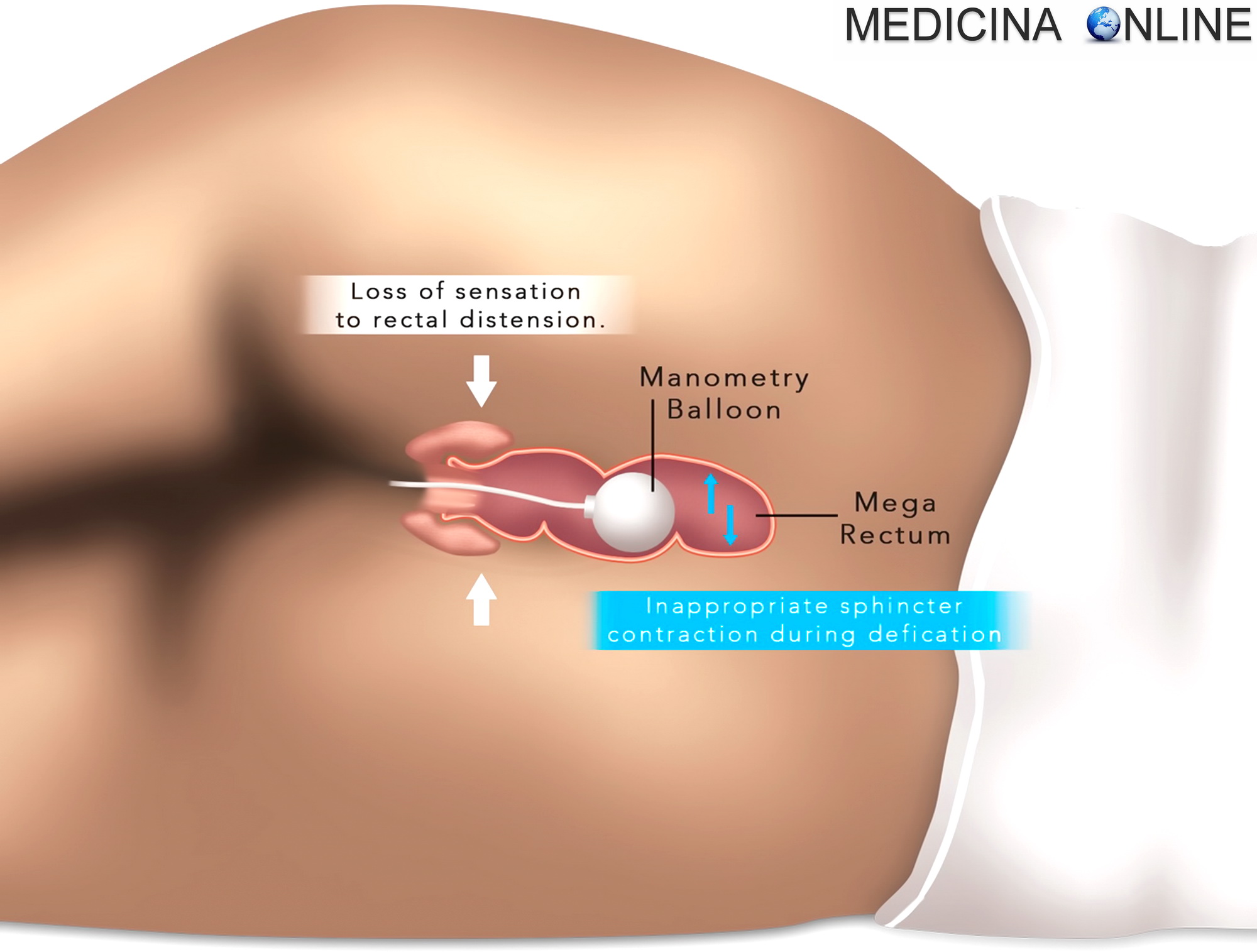 Manometria anorettale: preparazione, risultati, valori, costo | MEDICINA  ONLINE