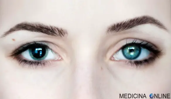 MEDICINA ONLINE MIDRIASI MIOSI ANISOCORIA PUPILLA IRIDE RETINA VISTA OCCHIO OCCHI COSTRIZIONE LUCE FISSA DROGHE FARMACOLOGIA MORTE FISSA REAZIONE PUPILLARE.jpg