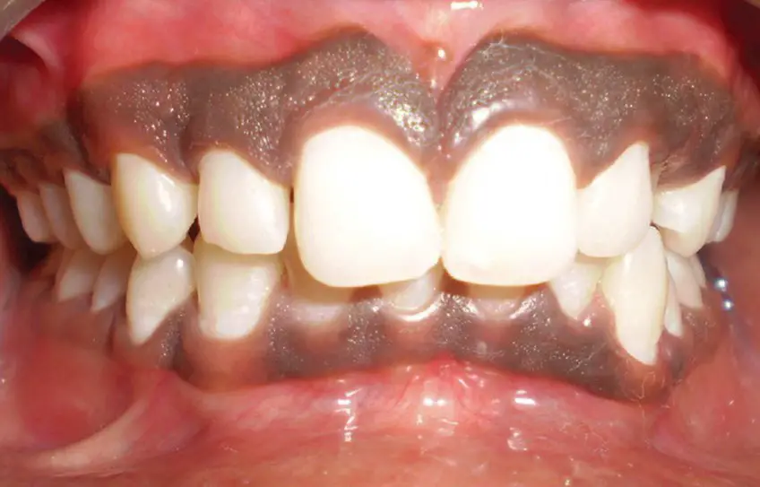 MEDICINA ONLINE Morbo di Addison IMMAGINE