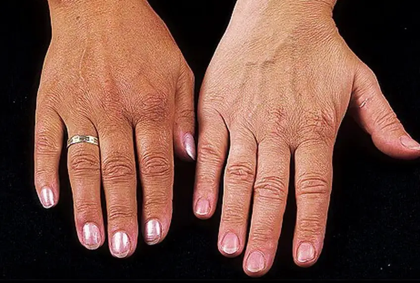 MEDICINA ONLINE Morbo di Addison IMMAGINE