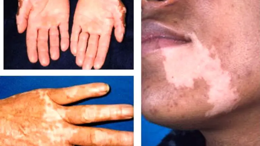 MEDICINA ONLINE Morbo di Addison IMMAGINE