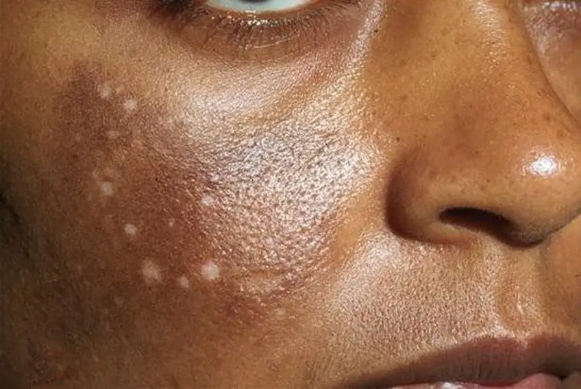 MEDICINA ONLINE Morbo di Addison IMMAGINE